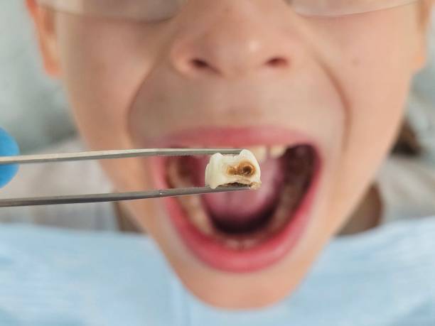 Best Emergency Tooth Extraction in Durand, WI